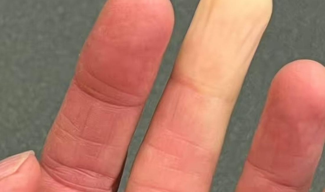 Dr. O’Donovan’dan Raynaud Uyarısı El ve ayak üşümesi sonrasında cilt renginde değişimler yaşanmasına neden