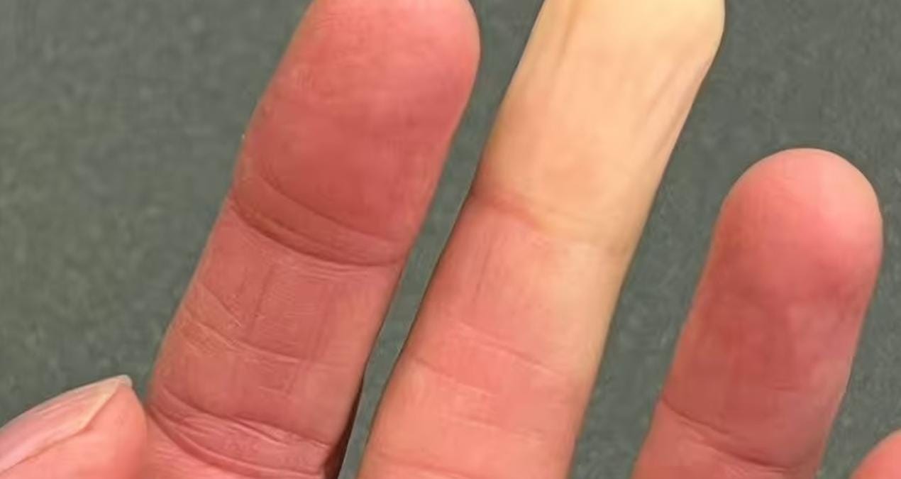 El ve ayak üşümesi sonrasında cilt renginde değişimler yaşanmasına neden