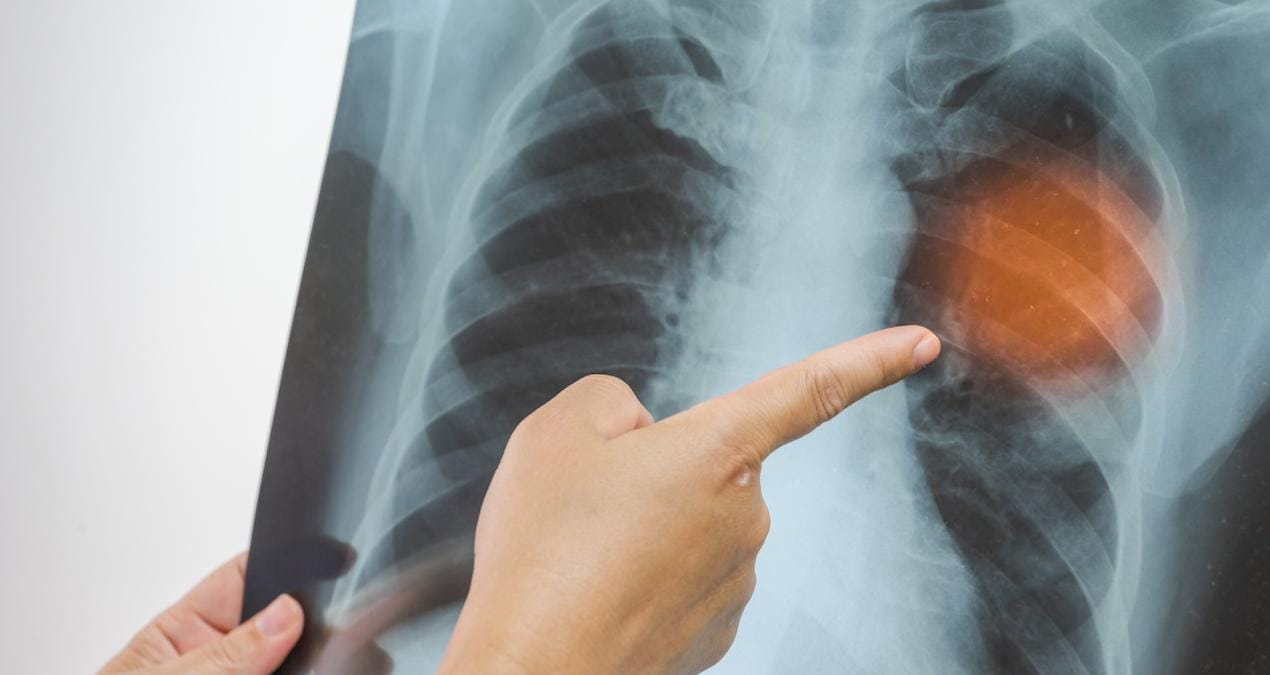 NHS’ten Zatürre Belirtileri ve Tedavi Süreci Hakkında Bilgilendirme Akciğer dokusundaki