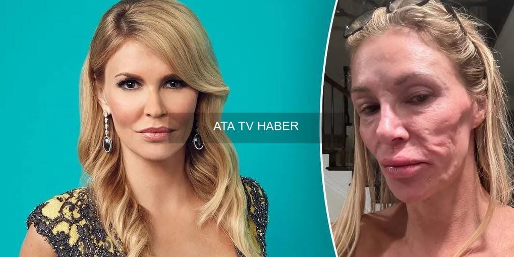 Brandi Glanville, İki Yıllık Yüz Deformitesinin Nedenini Belirledi