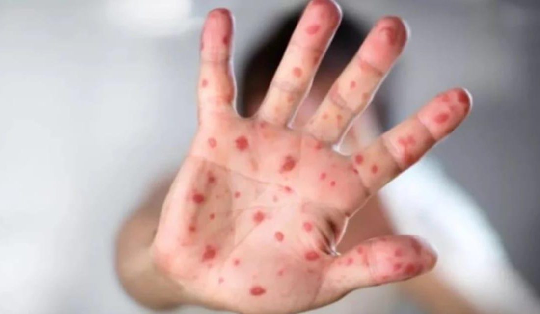 Güney Carolina’da Rekor Kızamık Salgını: CDC Ekipleri Bölgede Göreve Başlıyor