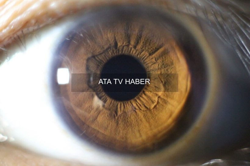 Masaj tabancasının gözlere verdiği hasar: İskoçya'da bildirilen ilk belgeli retinal diyaliz vakası