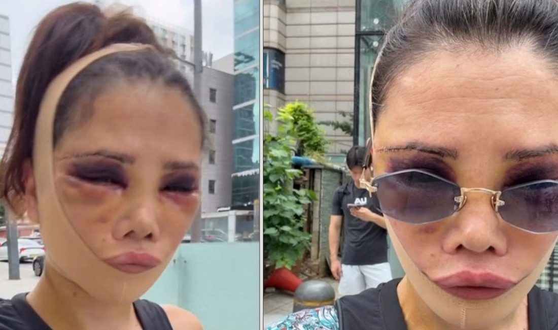 Didem Ceran ameliyat sonrası görünümünü ve duygularını paylaştı Survivor yarışmasıyla