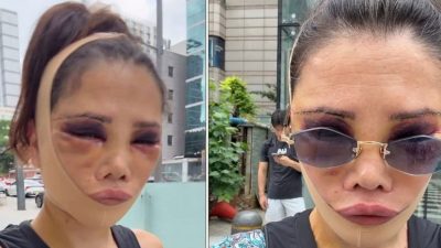 Didem Ceran ameliyat sonrası görünümünü ve duygularını paylaştı Survivor yarışmasıyla