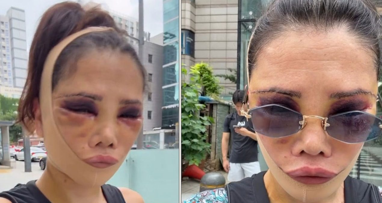 Didem Ceran ameliyat sonrası görünümünü ve duygularını paylaştı Survivor yarışmasıyla